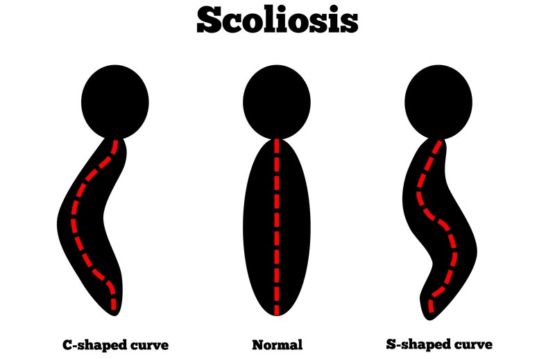 DeSoto, TX scoliosis treatment